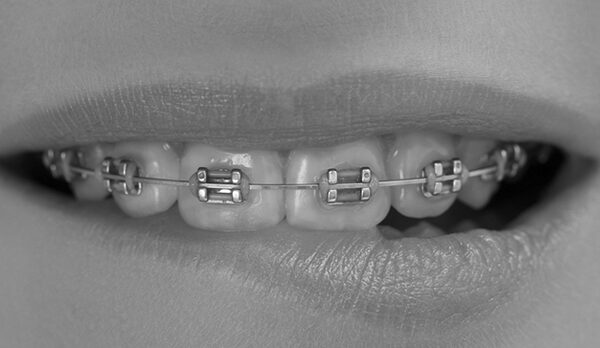 How Much Do Braces Cost in South Africa