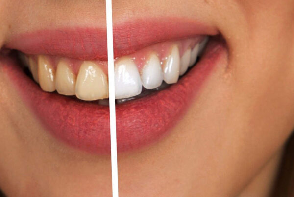 teeth whitening south africa