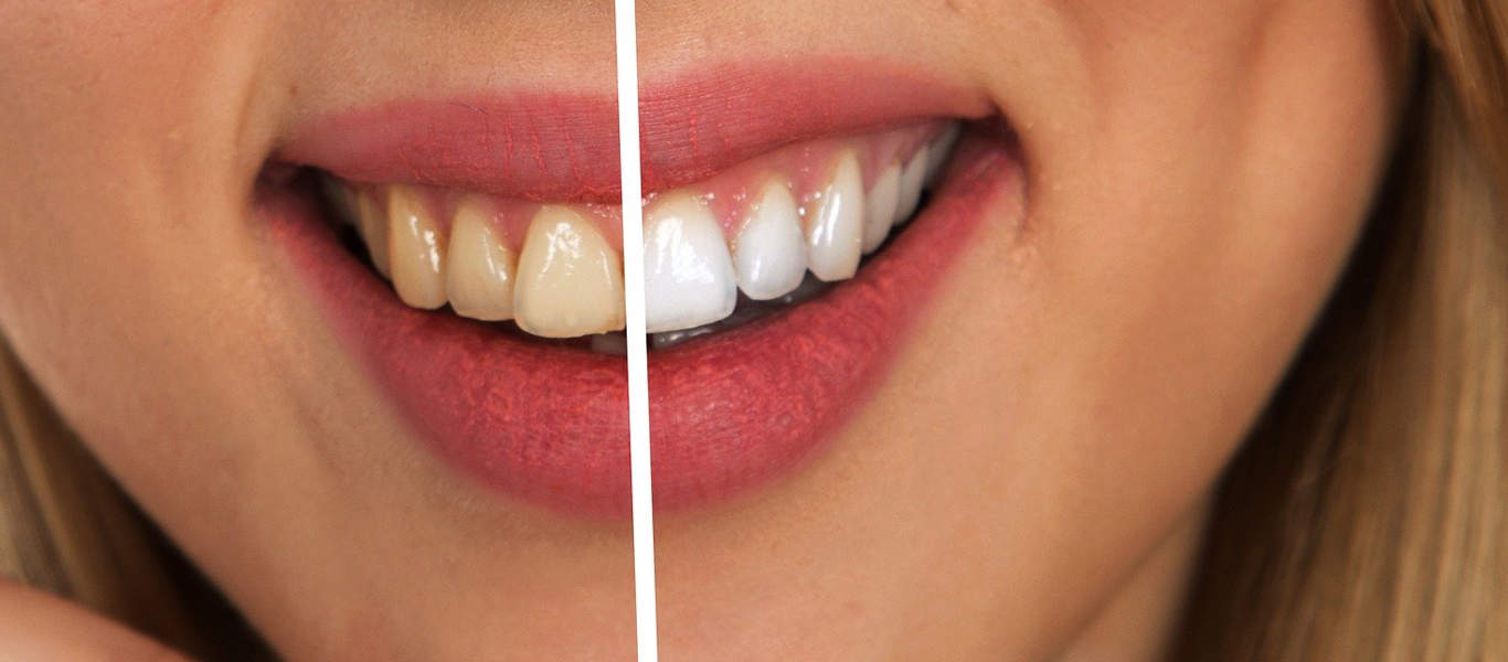 Recommended Teeth Whitening Kits South Africa